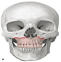 <p><strong>aka:</strong> <em>Guerin fracture, transmaxillary fracture</em></p><p><span>usually caused by a <strong>horizontal force</strong> to the maxilla.</span></p><ul><li><p><strong>key features:</strong></p><ul><li><p><span style="color: red;">floating jaw</span></p></li></ul></li></ul><ul><li><p><span>fracture <strong>passes through:</strong></span></p><ul><li><p><span style="color: red;">alveolar ridge</span></p></li><li><p><span style="color: red;">lateral nose</span></p></li><li><p><span style="color: red;">inferior wall of the maxillary sinus</span></p></li></ul></li><li><p><span><strong>separates the maxilla from:</strong></span></p><ul><li><p><span style="color: red;">pterygoid plates</span></p></li><li><p><span style="color: red;">nasal structures</span></p></li></ul></li></ul><p></p>