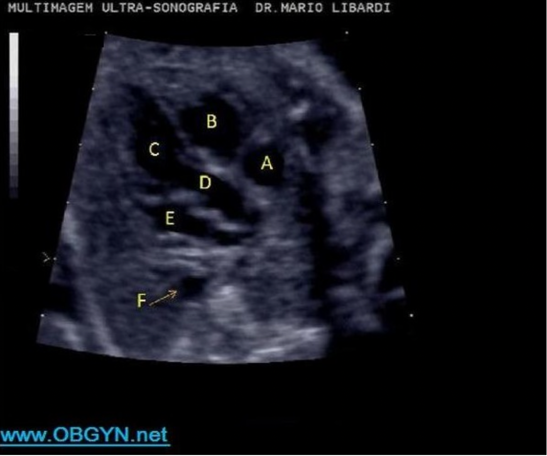 <p>Letter B indicates which cardiac structure?</p><p>A. right ventricle</p><p class="p1">B. right atrium</p><p class="p1">C. left ventricle</p><p class="p1">D. LVOT</p><p class="p1">E. RVOT</p>