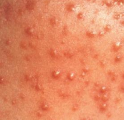 <p>mild inflammation of a hair follicle or oil gland; infected area is raised and red</p><p>raised, domed pustules form around hair follicles</p>