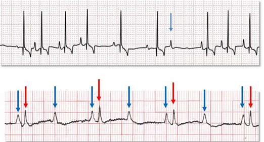 <p>What do these ECGs show?</p>
