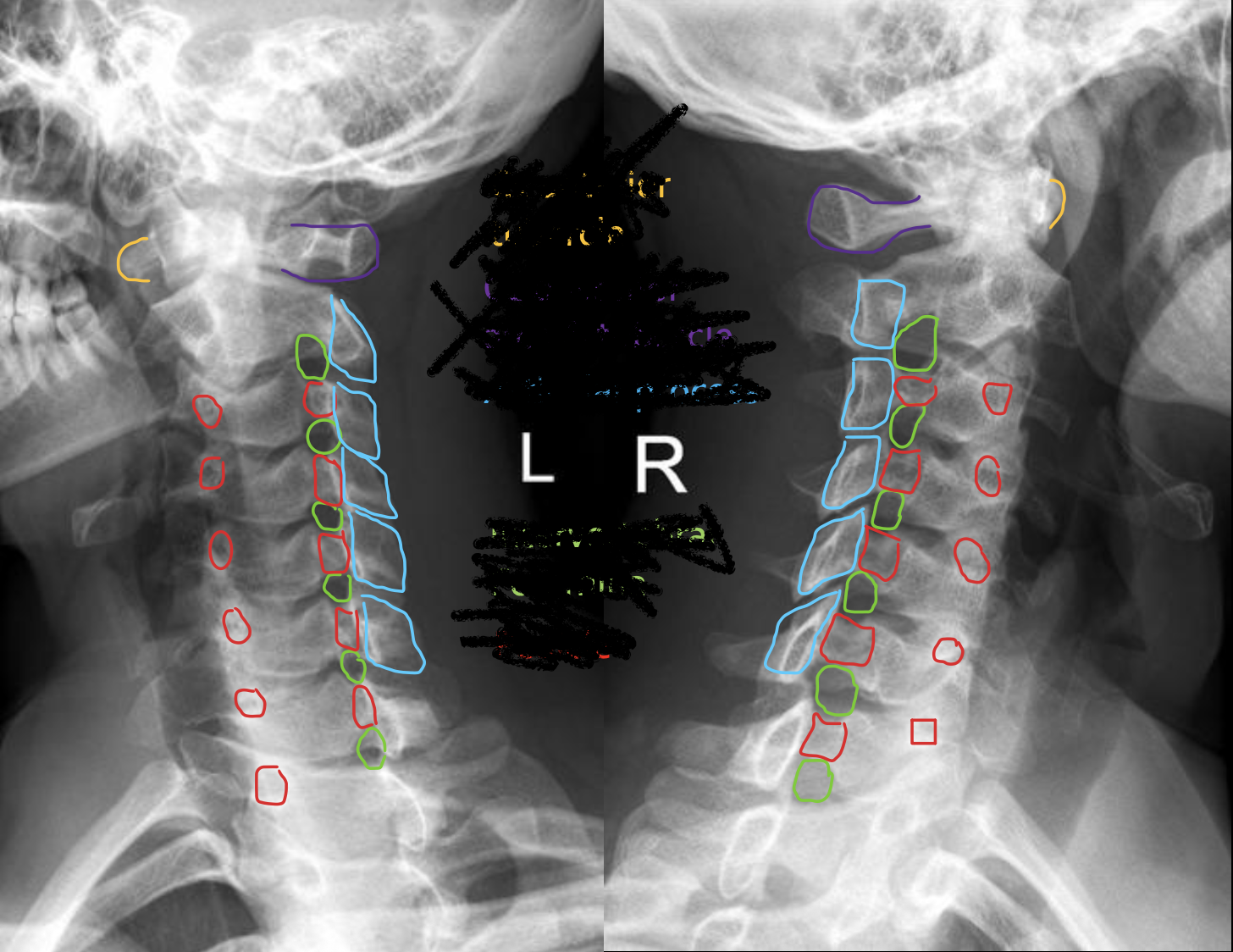 <p><span>椎间孔</span></p>