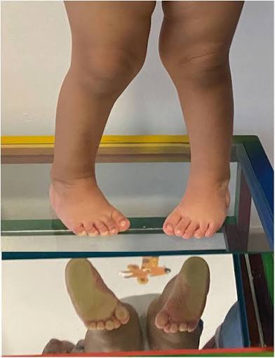 <p><span>Deformidad en la que el pie está desviado o torcido hacia la línea media del cuerpo.</span></p>