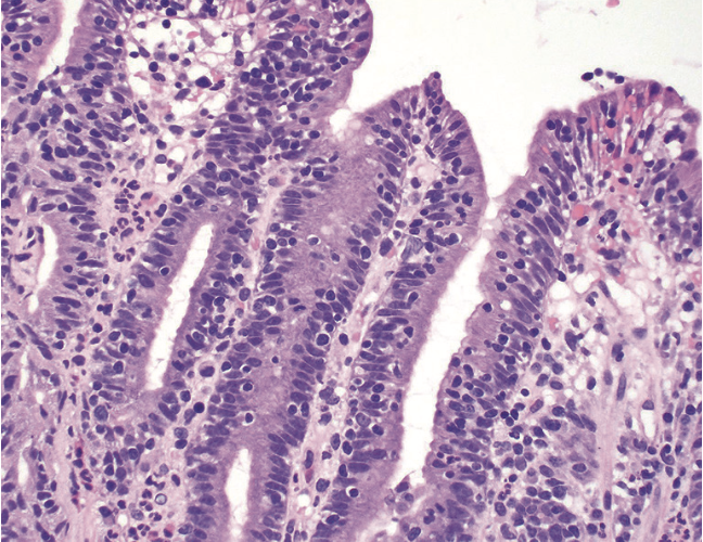 <p>1) Seuil pour la gastrite lymphocytaire</p><p>2) associations</p>