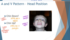 <p>What patients will likely want to put their chin down?</p>