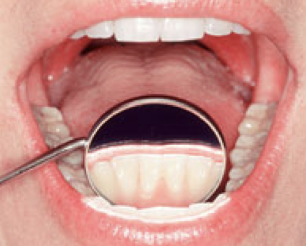 <p>View a tooth surface that can’t be seen directly</p>