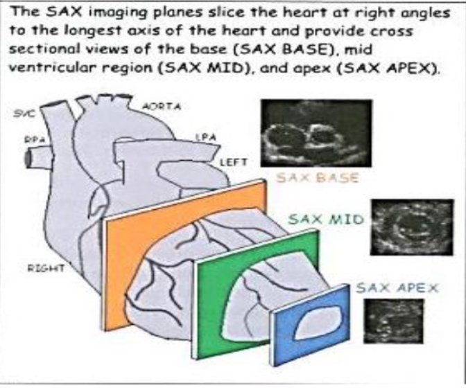 <p>PSAX </p>