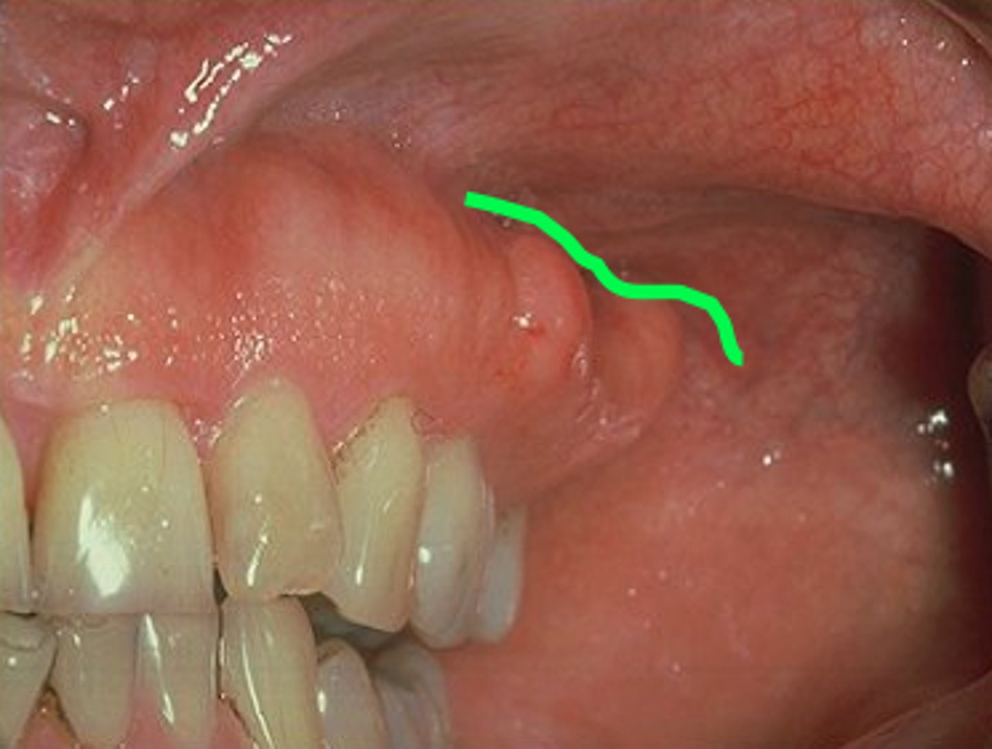 <p>where buccal mucosa meets alveolar mucosa</p>
