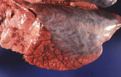 <p>Case 2: What is the Lesion Distribution?</p><p>a Focal</p><p>b Locally Extensive</p><p>c Multifocal/Coalescing</p><p>d Diffuse</p>