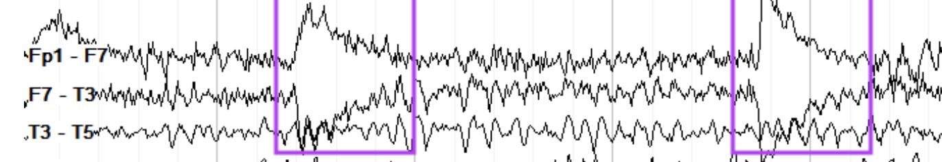 <p>Single electrode downward deflect after up, NO FIELD</p>