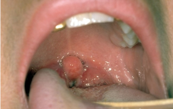 <p>Caused by <strong>Corynebacterium diphtheriae</strong></p><p>Symptoms due to exotoxin</p><p><strong>Exotoxin</strong> inhibits protein synthesis in epithelial cells by inactivating 80 S ribosomes.</p><p>Combination of dead tissue, WBCs, and scar tissue form <strong>pseudomembrane</strong></p><p><strong>Pseudomembrane</strong> can cause airway blockages.</p><p>Air passageway may swell shut.</p><p>Treated with antibiotics and antitoxin</p><p>Prevented by DTaP vaccine</p>