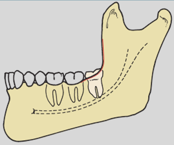 <p>the occlusal plane of the impacted tooth is at the same level as the occlusal plane of the second molar</p>