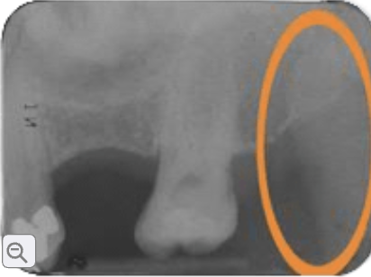 <p>coronoid process</p>