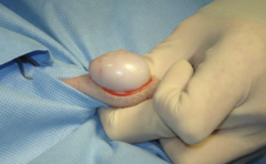 <p>What step of a closed castration is this?</p>