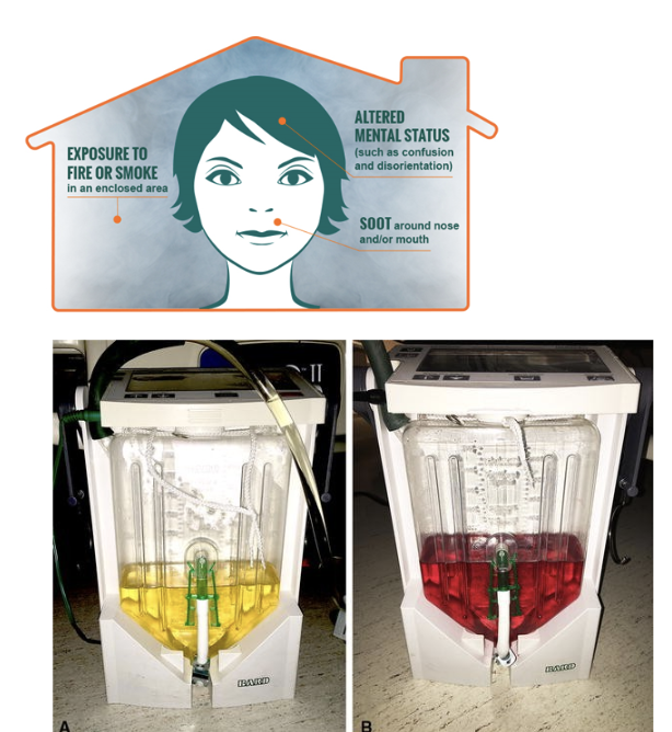 <p>inhalation injury</p><ul><li><p>caused by combustion of household synthetics (upholstery, carpet, plastic, vinyl) </p></li><li><p>impairs cellular respiration, leads to anaerobic metabolism → inc in serum lactate </p></li><li><p>suspect w/ unexplained hypotension, hypoxemia, and lactic acidosis </p></li><li><p>sx similar to CO poisoning (HA, dizzy, N)</p></li><li><p>antidote = <span style="color: red;"><strong>hydroxocobalamin</strong></span><strong> (CyanoKit)→ **causes RED discoloration of urine and body fluids </strong></p><ul><li><p>form of vit B12</p></li></ul></li></ul><p></p>