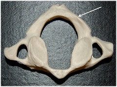 <p>disarticulated</p>