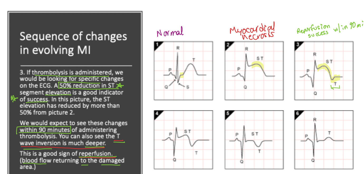 <p>The <strong>ST elevation typically reduces</strong> (by 50%) <strong><u>—reperfusion indicator</u></strong> <strong><u>(</u></strong>blood flow returning to damaged area)</p>