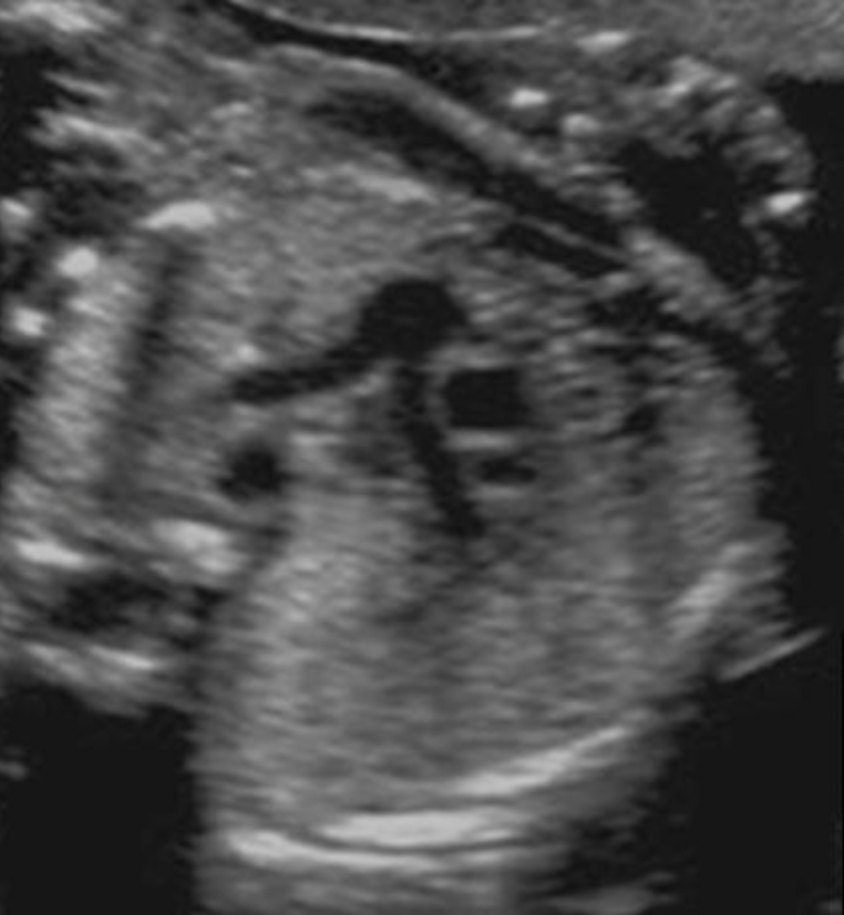 <p>Locate the superior vena cava</p>
