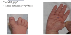 <p>- Short broad hands with large palmer crease</p><p>- Sandal gap on feet</p>