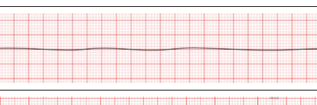 <p>what does this EKG show? (you’re cooked) </p>