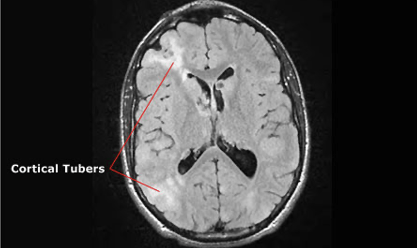 <p>epilepsy, cortical tubers, subependymal nodules, astrocytomas, TAND, cognitive deficits</p>