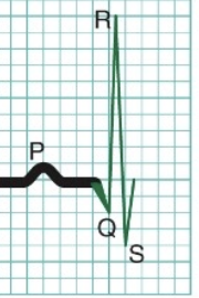 <p>QRS  = Depolar of ventricular contractile fibers</p>