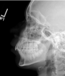 <p><span style="background-color: transparent;">Facial - LATERAL</span></p>