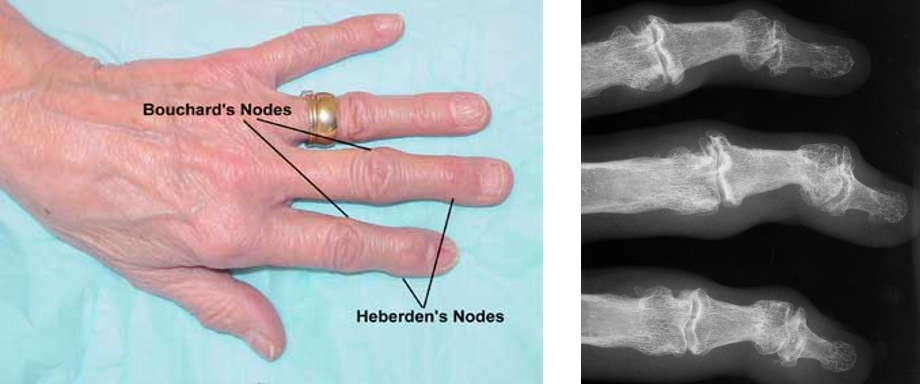 <ul><li><p>Symptoms</p><ul><li><p>Increase as day progresses</p></li><li><p>Pain during and after use</p></li><li><p>Bouchard’s (PIP) and Heberden’s (DIP) nodes</p></li><li><p>Majority of symptoms can be from soft tissue swelling</p></li></ul></li><li><p>Treatment</p><ul><li><p>Conservative</p><ul><li><p>NSAIDs/PO pain relievers</p></li><li><p>Aspiration/cortisone injection</p></li><li><p>Activity modifications</p></li><li><p>+/- intermittent PT/OT</p></li><li><p>+/- intermittent splinting</p></li></ul></li><li><p>Surgical</p><ul><li><p><strong>Can do a joint replacement → only definitive treatment but is a last ditch effort (have to exhaust all other options) </strong></p></li></ul></li></ul></li></ul><p></p>