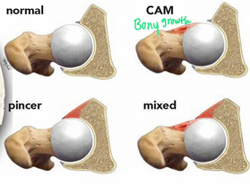 <p>Cam Deformity:</p><ul><li><p>Bony growth at the <span style="color: red;"><strong>femoral head/neck junction</strong></span></p></li><li><p>Repetitive stress/contact of the head/acetabular rim</p></li><li><p>Developmental condition</p></li></ul><p></p><p>Pincer Deformity:</p><ul><li><p><span style="color: red;"><strong>Overcoverage of the acetabulum</strong></span></p></li><li><p>The acetabular rim impinges on the femoral neck</p></li></ul><p></p>