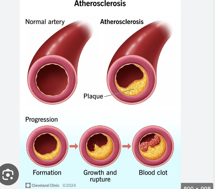 <ul><li><p>sensitive to stress</p></li><li><p>an underlying process for diseases</p></li><li><p><span>chronic, progressive disease where plaque—comprised of fat, cholesterol, and calcium—builds up inside artery walls, restricting blood flow and reducing arterial elasticity</span></p></li></ul><p></p>