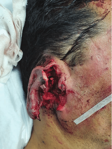 <p><span>forcible tearing off of skin or another part of the body, such as an ear or a finger</span></p>