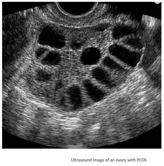 <ul><li><p>The definition of a cyst is a fluid-filled sac</p></li><li><p>Cysts can occur anywhere in the body</p></li><li><p>With PCOS, individuals <strong><em><u>can</u></em></strong> develop "cysts" due to eggs not being released over time</p></li><li><p>The follicles keep growing and form multiple "cysts"</p></li></ul><p></p>