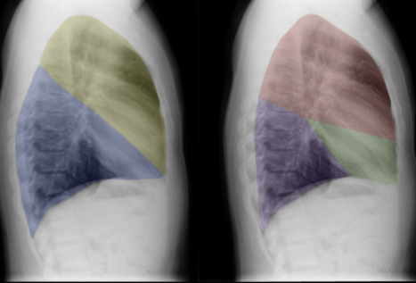 <p>on the LATERAL view, the area highlighted BLUE indicates:</p>