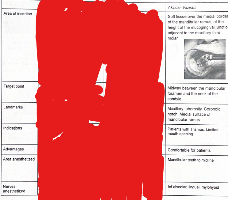 <ul><li><p>Patient = head tilted backwards and teeth closed gently</p></li><li><p>procedure:</p></li></ul><ol><li><p>ask the patient to gently close teeth</p></li><li><p>retract cheek; locate maxillary tuberosity</p></li><li><p>insert needle at Mucogingival junction above the mandibular 3rd molar area</p></li><li><p>keep the needle parallel to the maxillary occlusal plane</p></li><li><p>advance ~25mm Without contacting bone</p></li><li><p>aspirate</p></li><li><p class="has-focus">aspirate inject slowly</p></li></ol><p></p>