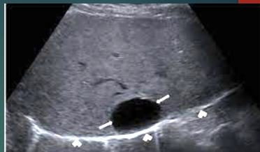 <p>Congenital cysts: True hepatic cysts</p>