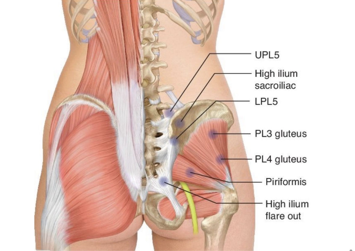<p><span>we just need to know UPL5 and Piriformis</span></p>