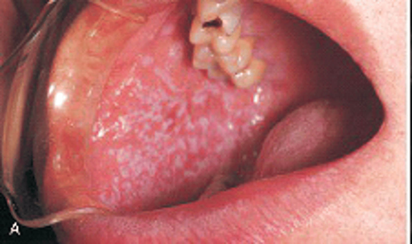 <p><br>Benign, chronic disease that affects the skin and oral mucosa</p><p>-White lines= Wickham Striae</p><p><span>The classic appearance of lichen planus affecting the oral mucosa is a pattern of interconnecting slender white lines referred to as?</span></p>