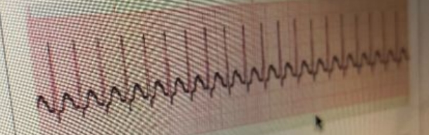 <p>What is the ECG rhythm above</p><p>i. Supraventricular tachycardia</p><p>ii. Sinus tachycardia</p><p>iii. Ventricular tachycardia</p><p>iv. Normal sinus rhythm</p>