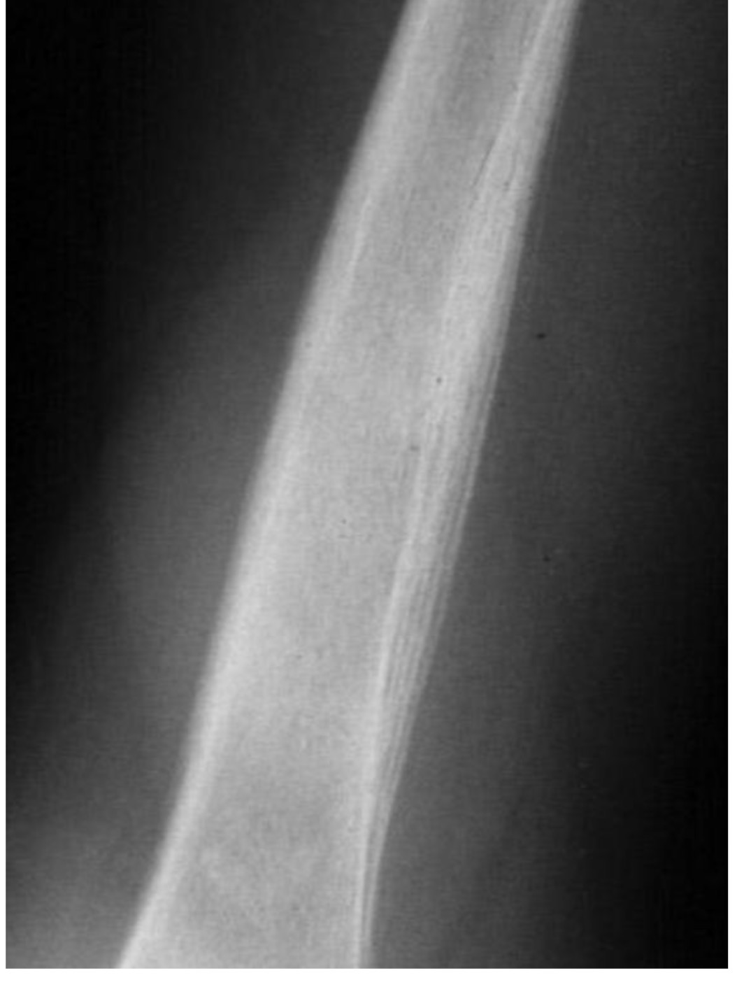 <p>Phản ứng màng xương dạng</p>