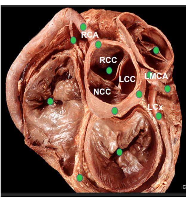 <p>- semilunar </p><p>- based on where coronary arteries originate </p><p>1. Left coronary cusp (LCC) </p><p>2. Right coronary cusp (RCC) </p><p>3. Non coronary cusp (NCC)</p>