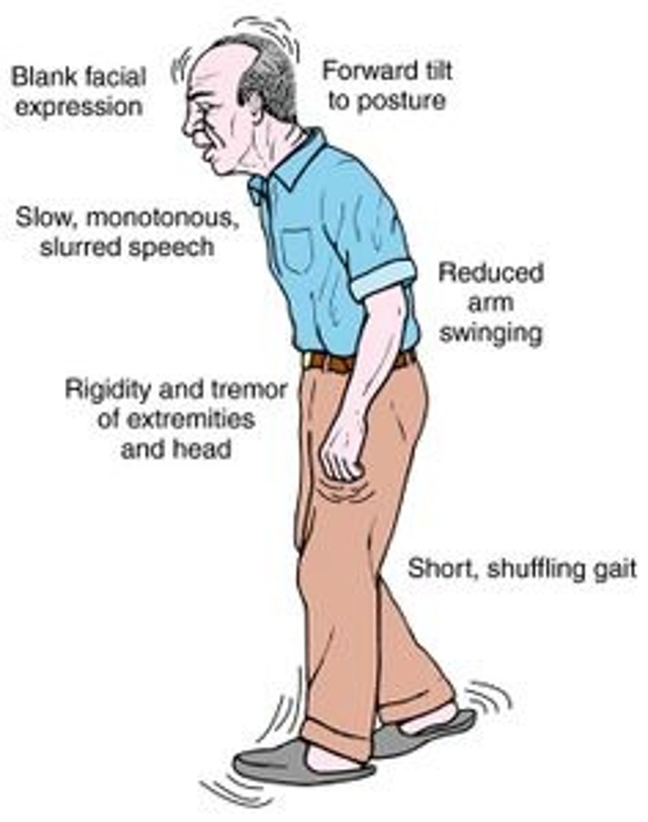<p>This disease typically affects people in their fifties and sixties. It results from a degeneration of the dopamine-releasing neurons of the substantia nigra. Afflicted individuals have a persistent tremor at rest, a forward walking posture, and a stiff facial expression.</p>