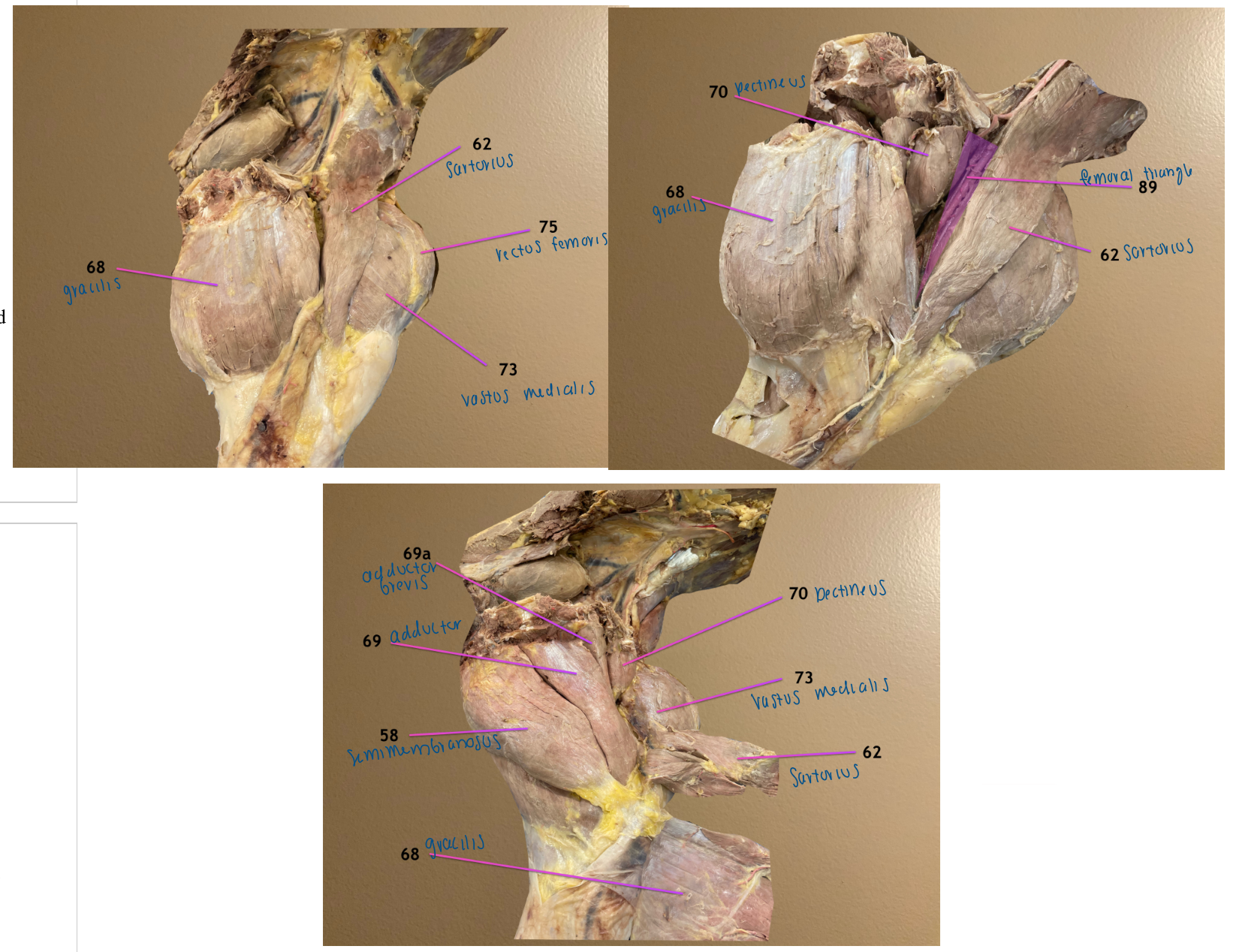 <p>69a: adductor brevis: hip adductor</p><ol start="70"><li><p>pectineus m.: hip adductor</p></li></ol><ol start="89"><li><p>femoral triangle: area between sartorius (62) cranially &amp; pectineus (70) caudally</p></li></ol><p></p>