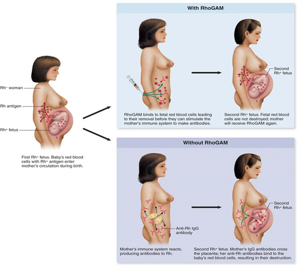 <p><span>IgG antibodies against Rh antigen are produced by an Rh- mother following delivery of her first Rh+ child. </span></p><p><span>During subsequent pregnancies with Rh+ children, IgG antibodies cross the placenta and destroy fetal RBC’s</span></p>