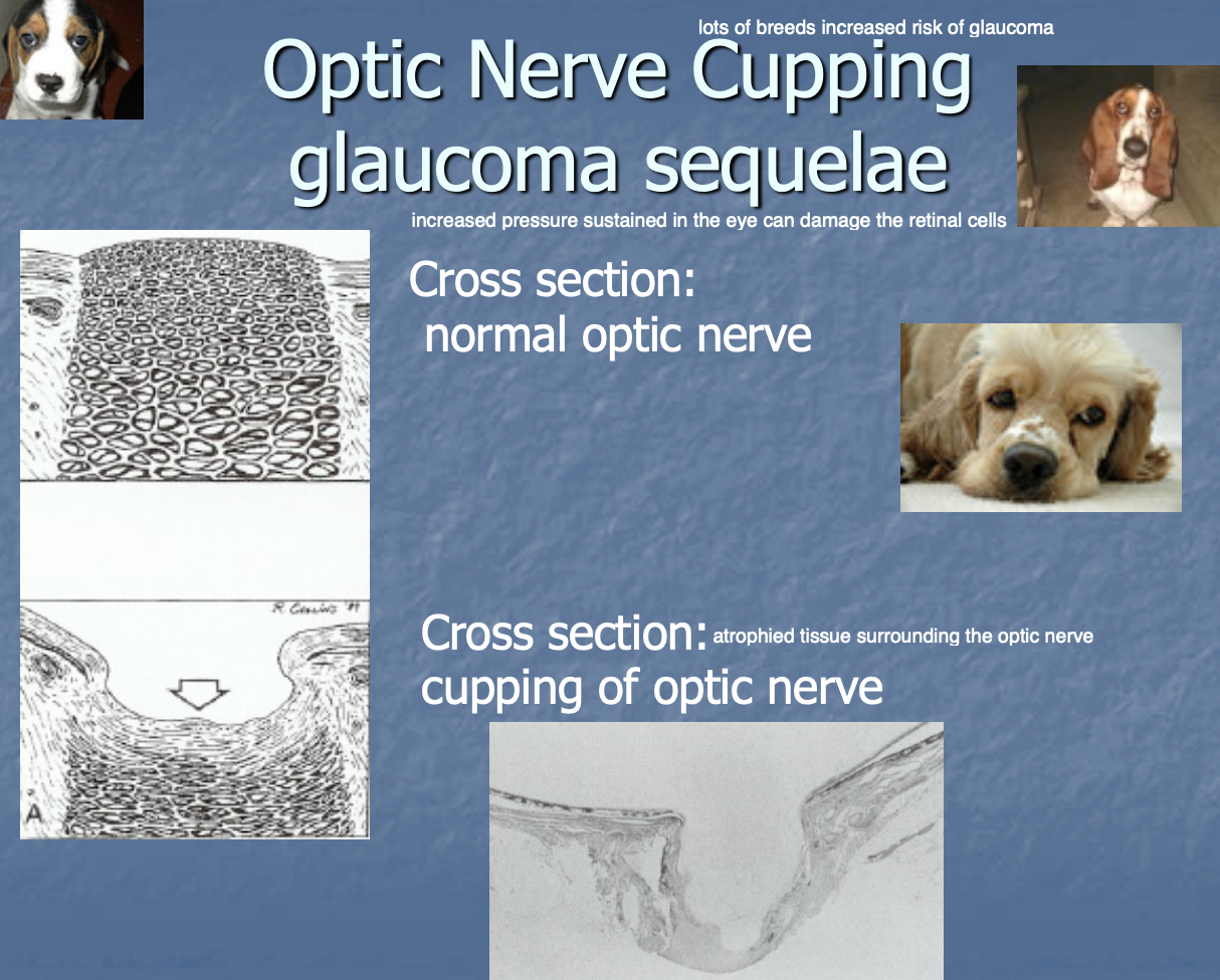 <p>abnormal depression in optic disc (assoc w/ glaucoma)</p>