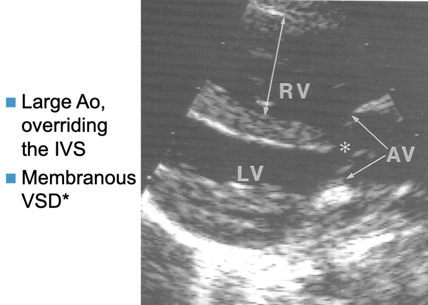 <ul><li><p>Combination of 4 congenital lesions:</p></li></ul><ol><li><p>membranous VSD</p><ol><li><p>anterior + rt displacement</p></li></ol></li><li><p>overriding Ao (over the IVS)</p><ol><li><p>may be infundibular / subinfundibular stenosis</p><ol><li><p>usually d/t posterior malalignment of IVS from overriding Ao</p></li></ol></li><li><p>PV or PA may be atretic</p></li></ol></li><li><p>RVOTO / PS</p></li><li><p>RVH</p><ol><li><p>d/t obstruction</p></li></ol></li></ol><p></p>