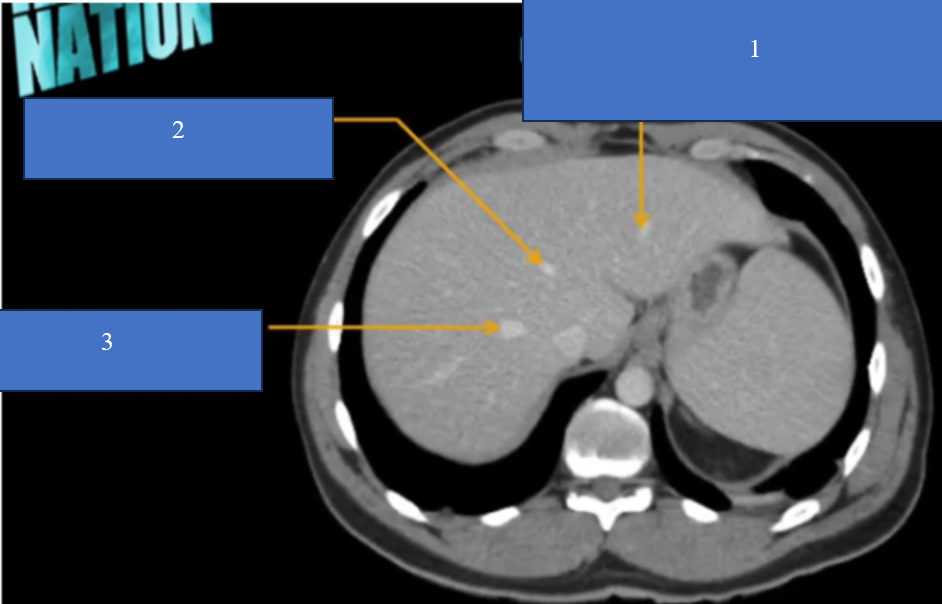 <p>TM gan ở đâu? TM chủ dưới ? ĐM chủ?</p>