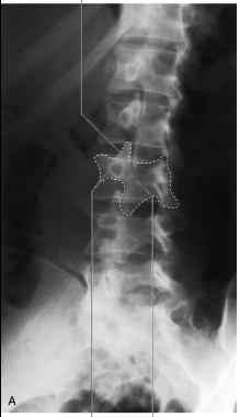 <p>The scottie dog formed by the body and posterior formations. </p>