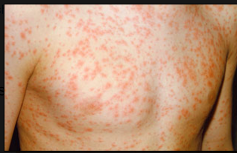 <p>Causative Agent: Rubivirus<br>Symptoms/Signs: Widespread rash on the trunk and extremities resolving within 3 days; causes extreme harm to fetus in utero</p>