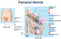 <p>A femoral hernia occurs when the intestine enters the canal carrying the femoral artery into the upper thigh.</p><p>-most common in women, especially those who are pregnant or obese.</p><p>-Less common than inguinal hernias but have a higher risk of strangulation.</p>