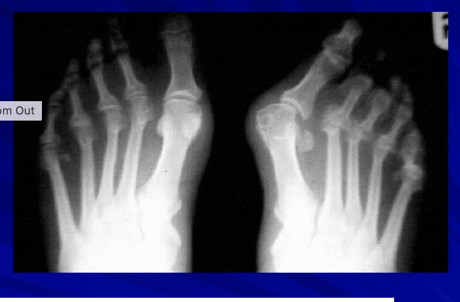 <p>What is “hallux valgus”? MOI?</p>
