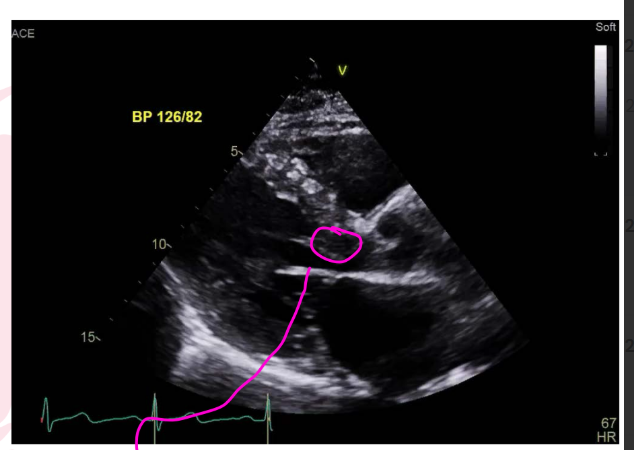 <p>SAM can cause an <strong>endocardial plaque</strong> on the <strong>interventricular septum</strong>, or <strong>IVS</strong>.</p><p>(2D might see hyperechoic area / mcrio injury to the septum)</p><p><strong>Simple reminder:</strong><br>Repeated mitral valve contact with the septum can create a plaque area on the IVS.</p>